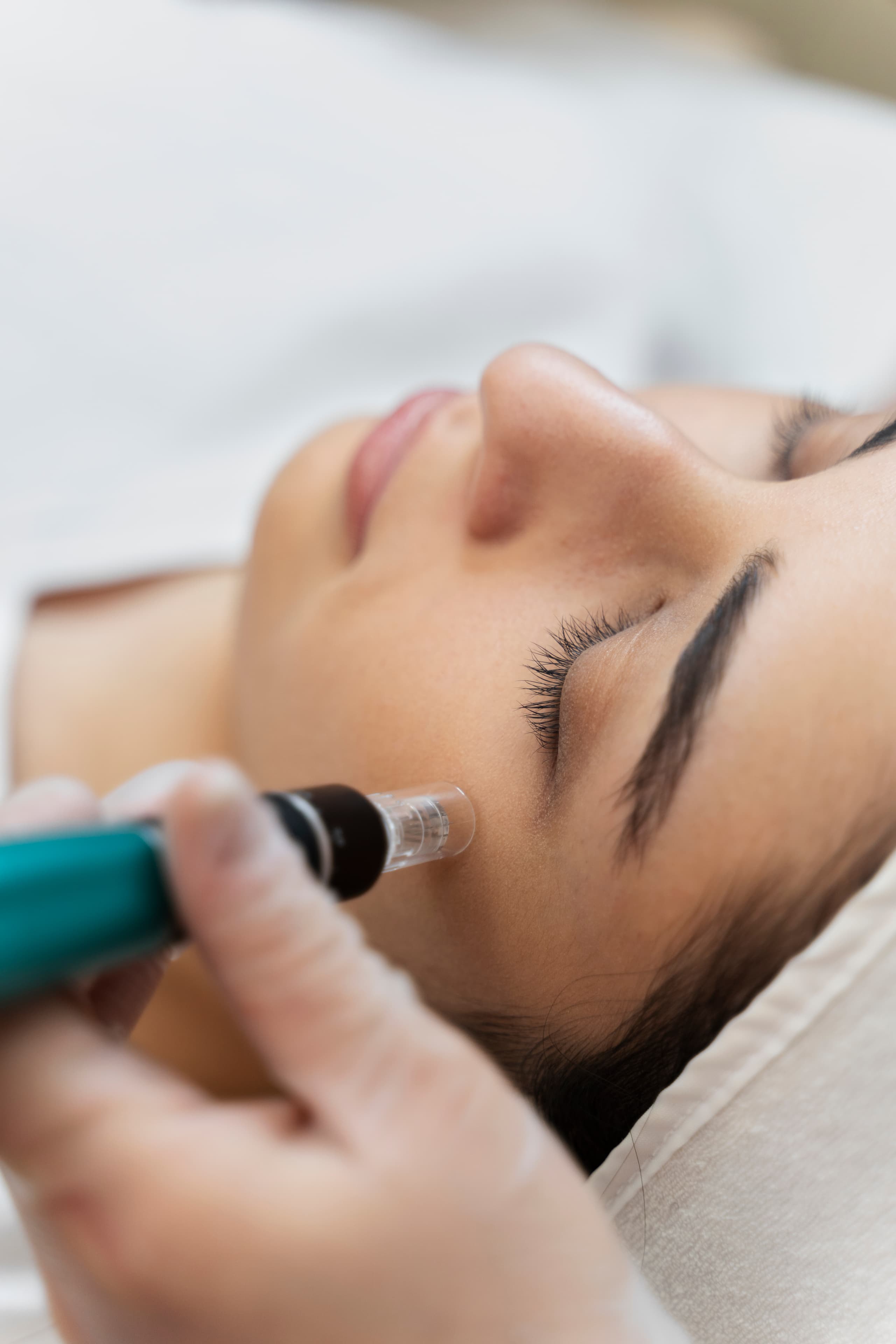 Aplicação de microagulhamento facial